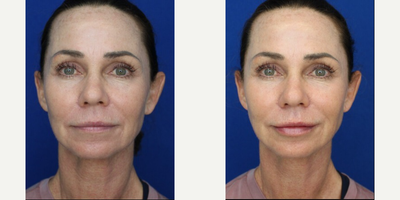 Woman treated with Lip Fillers - Woman treated with Lip Fillers