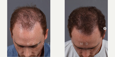 Man treated with PRP for Hair Loss, PRF Treatment - Look at these amazing results from PRFM hair restoration!PRFM (Platelet-Rich Fibrin Matrix) therapy is revolutionizing hair restoration! PRFM harnesses the power of your own blood to stimulate hair growth and rejuvenate the scalp. Heres how it works: A small sample of your blood is processed to isolate platelets and growth factors. These potent components are then injected into the scalp, where they promote hair follicle regeneration and improve blood circulation. The results speak for themselves  thicker, fuller hair and a healthier scalp!