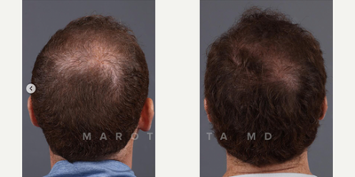Man treated with PRP for Hair Loss, PRF Treatment - Look at these amazing results from PRFM hair restoration!PRFM (Platelet-Rich Fibrin Matrix) therapy is revolutionizing hair restoration! PRFM harnesses the power of your own blood to stimulate hair growth and rejuvenate the scalp. Heres how it works: A small sample of your blood is processed to isolate platelets and growth factors. These potent components are then injected into the scalp, where they promote hair follicle regeneration and improve blood circulation. The results speak for themselves  thicker, fuller hair and a healthier scalp!