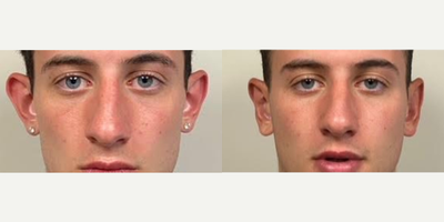 18-24 year old man treated with Ear Surgery - 30 days after an ear pinning surgery