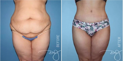 Woman treated with Butt Lift - Woman treated with Natural Butt Lift as well as Tummy Tuck