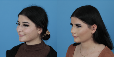 18-24 year old woman treated with Rhinoplasty - Even if it's 10 days the change looks so great