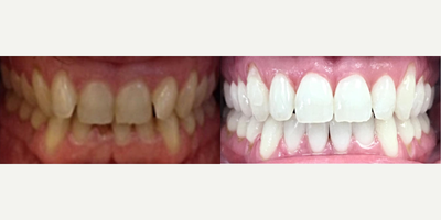 Person treated with Smile Makeover, Zoom Whitening - Smile transformation with Invisalign and zoom whitening. Lookin' good! Treatment time: 10 months. Future treatment includes recontouring the edges of the teeth and periodontal treatment of the gumlines on lowers.