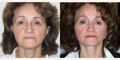 Woman treated with Facelift - Woman treated with Facelift