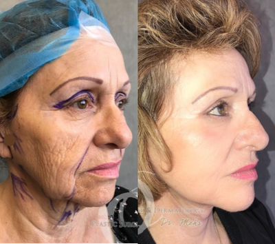 Woman treated with Chemical Peel - Woman treated with Chemical Peel (deep chemical skin treatment), shown 2 weeks post op. Patient also had laser treatment as well as Mehr design full facelift, extended neck lift, and upper eyelid surgery.