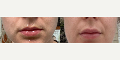 Woman treated with Vollure - Woman treated with Lip Fillers using 1 vial of Vollure