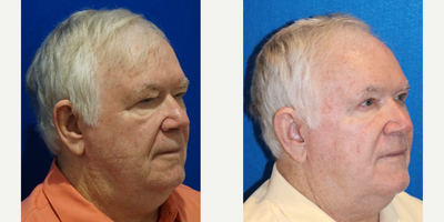 Man treated with Brow Lift, Eyelid Surgery - Endoscopic Browlift and Upper Blepharoplasty