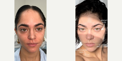 Woman treated with CO2 Laser, PlasmaPen, PRP Injections - Woman treated with CO2 Laser, PlasmaPen, PRP Injections
