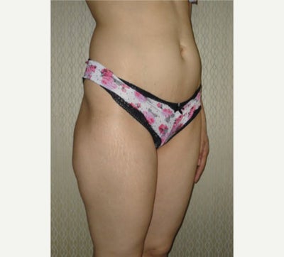 25-34 year old woman treated with Liposuction, Vaser Liposuction, Brazilian Butt Lift - Vaser Liposuction