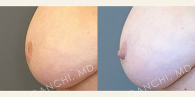 55-64 year old woman treated with Nipple Surgery, Inverted Nipple Surgery - 57 year old woman who underwent repair of inverted nipples bilaterally under local anesthesia alone. Shown before and 11 months after surgery with maintained eversion and natural shape bilaterally.