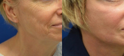 55-64 year old woman treated with Renuvion Skin Rejuvenation - Concurrent Rhytidectomy