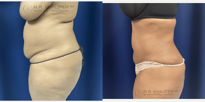 35-44 year old woman treated with Mini Tummy Tuck - Mini Tummy Tuck