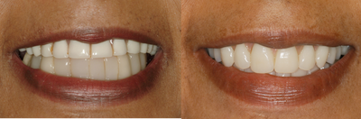 Replacement of hopeless teeth with implant supported bridge. - 
	This patient presented with hopeless bottom teeth and breaking restorations. Four implants were placed in the bottom jaw and missing teeth were restored with a fixed bridge. Full denture was made for the top jaw.
