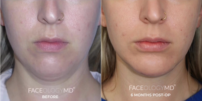 Woman treated with Chin Liposuction - Woman treated with Chin Liposuction