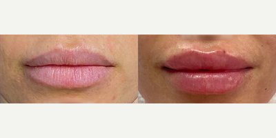 Woman treated with Lip Fillers - Woman treated with Lip Fillers