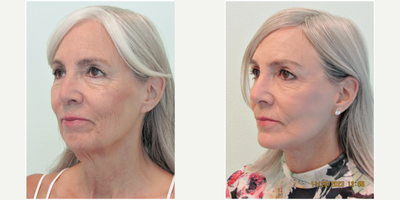 60+ year old woman treated with Lower Facelift, Neck Lift, and Chin Implant - This very active woman in her 60s presented with the complaint of excessive drooping of her neck and jawline. She stated that she never had a strong profile even in her younger years, and wished for more definition and a decrease in the overall heaviness of her face. Examination revealed significant laxity of her jawline and neck tissue, along with a moderately undersized chin.We decided together to perform a lower facelift and neckift, along with adding a silicone chin implant to increase her profile definition.The entire procedure was performed under local anesthesia (no IV or general anesthesia) with oral sedation with xanax. The entire procedure took 2 1/2 hours to perform. Her results demonstrate significant improvement in her jawline angle as well as marked improvement in her neck profile.