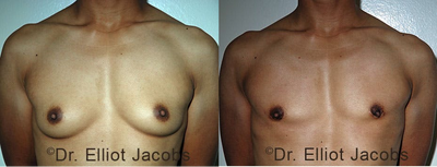 Female to Male Chest Masculinization Surgery - Female to Male Chest Masculinization Surgery