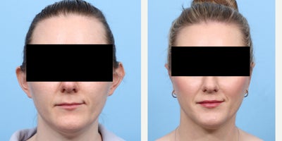 35-44 year old woman treated with Ear Surgery - This 38-year-old patient came to Dr. Wise feeling self-conscious about the prominence of her ears. With a subtle and refined otoplasty, she now feels more confident and comfortable with her appearance. Her results are a beautiful example of how a small change can make a big difference.