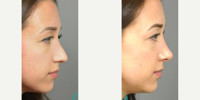 Woman treated with Revision Rhinoplasty - After having a primary rhinoplasty procedure with another surgeon, she still desired correction of the residual dorsal hump as well as a bit more rotation and definition of the nasal tip.
