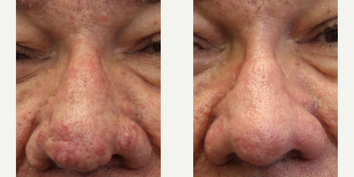 55-64 year old man treated with Dermabrasion to the nose for Rhinophyma - Dermabrasion to the nose for Rhinophyma