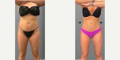 25-34 year old woman treated with AirSculpt - In our office, our patient continues her journey and experience with AirSculpt, she elaborates on how great she feels in her new body. She was able to target her thighs, abdomen and smoothly transferred that stubborn fat to her buttocks!