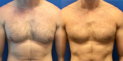 25-34 year old man treated with surgery for gynecomastia - gynecomastia with liposuction of chest and inferior periareolar incision to remove glandular tissue