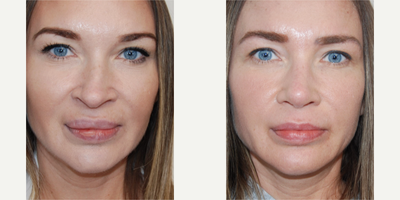 35-44 year old woman treated with Lip Reduction - Our beautiful patient is seen 7 months following functional and cosmetic rhinoplasty surgery., and one month following upper lip reduction surgery. She had chronic nasal obstruction and she was dissatisfied with her crooked, wide nasal appearance and her bulbous droopy tip. The rhinoplasty techniques we used included a columella strut graft to support her tip, and a left spreader graft to aid in nasal straightening, and bilateral lateral crural strut grafts to support her congenital external nasal valve collapse, and alarplasty to narrow her nostrils. We also performed a turbinate reduction. You can see a narrower nasal appearance in her bridge tip and nostrils, and on profile, you can see that her nasal tip is no longer droopy.She also has a history of silicone injections to her lips performed elsewhere. He was dissatisfied by her overcorrected and lumpy upper lip appearance. We performed an upper lip reduction surgery in the office with local anesthetic, and one month later, you can see a natural looking upper lip appearance. She has a small bump in her right lower lip that will be addressed soon.
