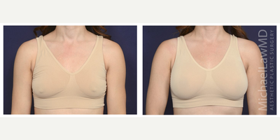 35-44 year old woman treated with Natrelle Breast Implants - Breast augmentation. Follow-up photo taken 3 months after the procedure.