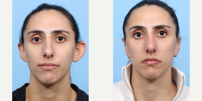 25-34 year old woman treated with Ear Surgery - This patient wanted to decrease the protrusion of her ears. Dr. Wise performed an otoplasty to achieve the desired result. Her before and after images demonstrate significant improvement with reduction of the prominent appearance of the ears as well as improved contours of the folds within the ears. The patient was very pleased with the aesthetic outcome.