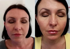 45-54 year old woman treated with Silhouette Soft - Silhouette Soft procedure before and after.