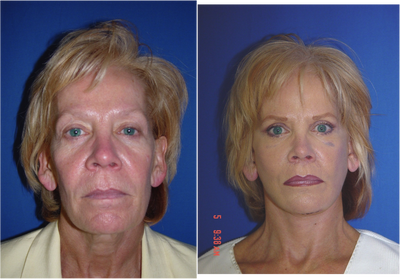 Facial Rejuvenation - Facial Rejuvenation Before & After Photos