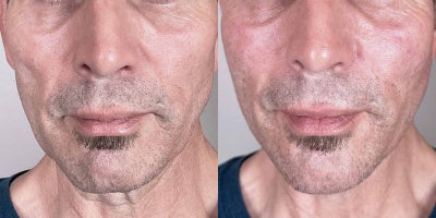48-year old man treated with Vollure, Voluma, Restylane Contour - Liquid Facelift - This liquid facelift using Vollure, Voluma, and Restylane Contour enhanced facial contours, softened wrinkles, and restored volume for a more youthful and refreshed appearance.