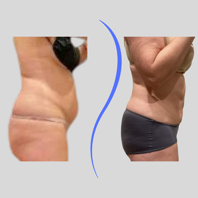 45-54 year old woman treated with Funsculpting HD Liposuction - Patient treated with Funsculpting abs + flanks, 1 session. Reduces waistline 3 inches, photos 90 days apart.