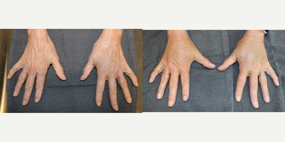 65-74 year old woman treated with ALMI - ALMI Hands