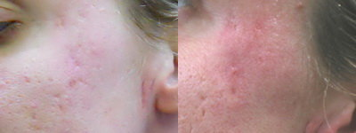 Acne/Acne Scars Treatment with Smoothbeam - 
	Acne/Acne Scars Treatment with Smoothbeam
