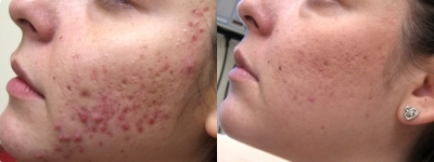 Acne/Acne Scars Treatment with Smoothbeam - 
	Acne/Acne Scars Treatment with Smoothbeam
