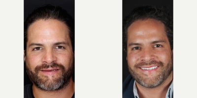 Man treated with Smile Makeover - Opening this patients bite with full mouth reconstruction by Dr. Young gave him back his youthful smile he had years before clenching, grinding, and trauma broke down his teeth.