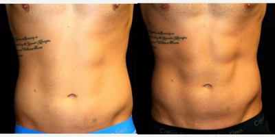 35-44 year old man treated with UltraShape Power - 35-44 year old man treated with UltraShape Power
