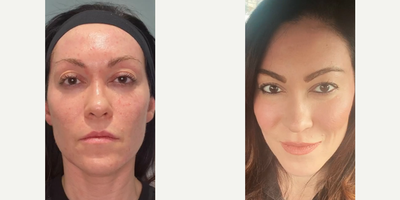 Woman treated with Sculptra, Microneedling RF, Halo Laser, PRP Injections - Woman treated with Sculptra, Microneedling RF, Halo Laser, PRP Injections
