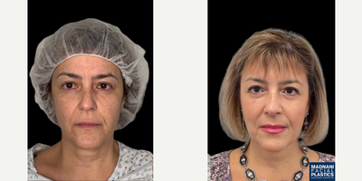 45-54 year old woman treated with Cheek Augmentation - 54 y.o female who was concerned with  hollowness of her mid face. She underwent facial fat transfer of cheek, tear trough and nasolabial folds under local anesthesia. At 1 month post-op, her mid face is volumized resulting in a youthful appearance.