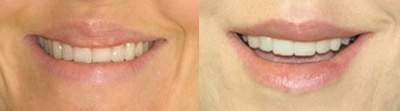 Lip Surgery, Lip Reduction - 
	This is a good demonstration of a patient that had overly injected lips ( before) of some substance that deformed her lips. After revision surgery below.
