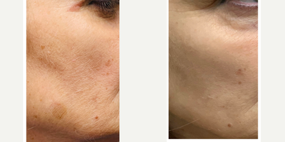 45-54 year old woman treated with Lumecca - 3 IPL for brown spots