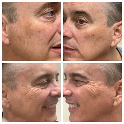 45-54 year old man treated with Lumecca - 2 treatments of IPL (Lumecca)