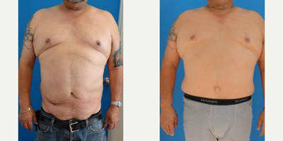 35-44 year old man treated with Panniculectomy - Panniculectomy with abdominoplasty and lower back liposuction.
