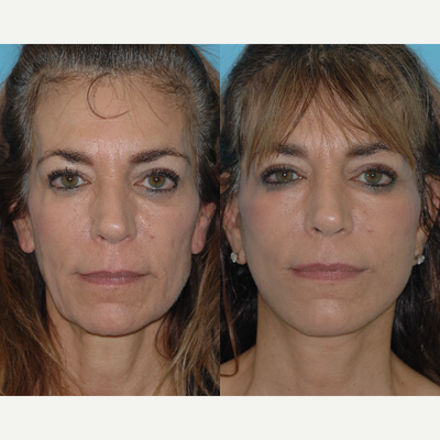 55-64 year old woman treated with Deep Plane Facelift - Patient who underwent an extended deep plane face lift as part of her facial rejuvenation. Healing and doing great!