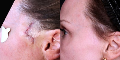 45-54 year old woman treated with Mohs and Reconstruction Followed by Dermabrasion, DeepFX, and Vascular Laser - Take a look at this patient's beautiful results. Dr. Khorasani removed this patient's cancer via mohs micrographic surgery and reconstruction. The before photo shows the patient 1 week after surgery. At 6 weeks post surgery, Dr. Khorasani performed scar resurfacing procedures dermabrasion and fractional CO2 laser (deepfx), followed by a series of pulse dyed laser treatments (vbeam).