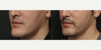 25-34 year old man treated with Beard Transplant - FUE 2500 grafts before and after