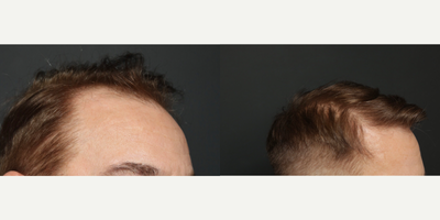 35-44 year old man treated with FUE Hair Transplant - FUE 2000 grafts before and after