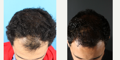 25-34 year old man treated with Hair Transplant - FUE 1800 grafts + PRP