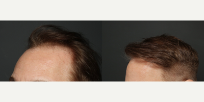 35-44 year old man treated with FUE Hair Transplant - FUE 2000 grafts before and after